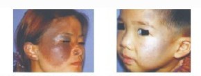 Treatment illustration
