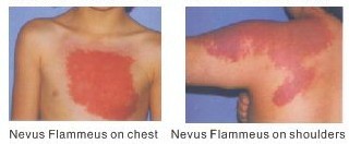 Treatment illustration